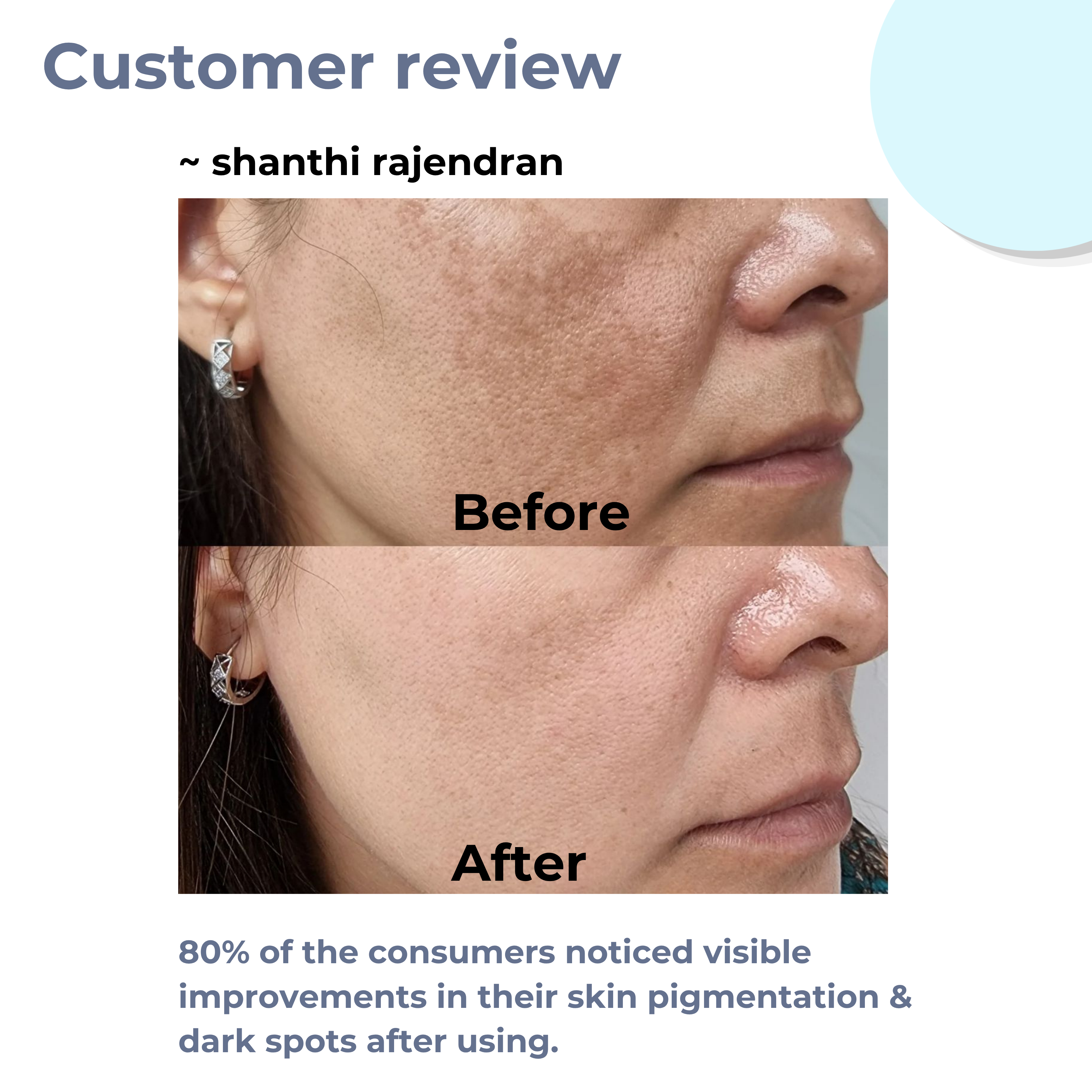 Before and after hyperpigmentation treatment using ReachHabits dark spot face wash.