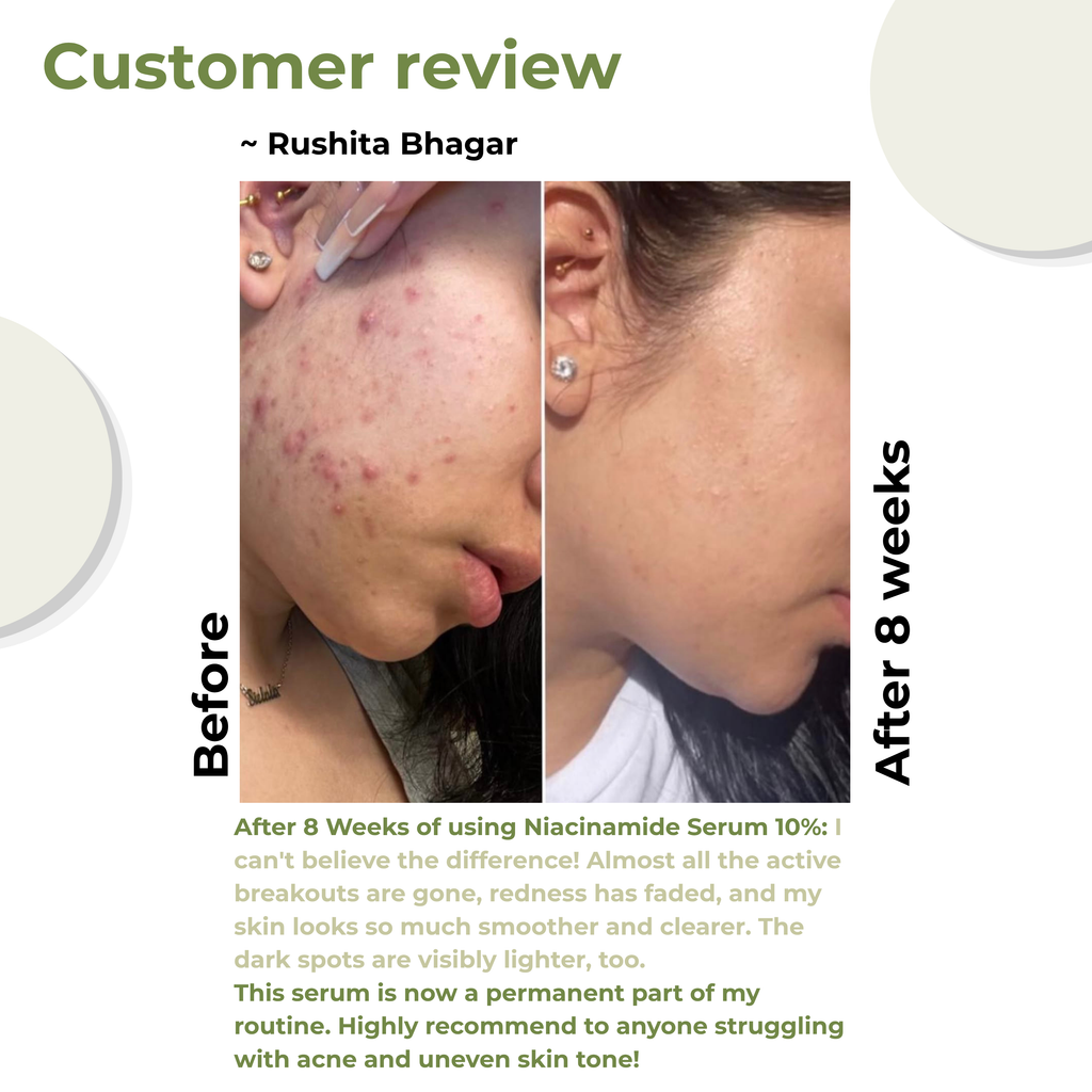 Before and after customer review showing severe red breakouts clearing into smooth, calm skin with visibly lighter dark spots after 8 weeks of using the ReachHabits 10% Niacinamide serum.