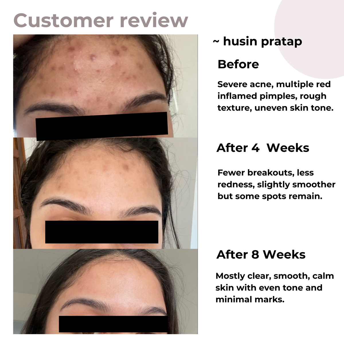 Before and after customer review showing severe acne and inflamed pimples clearing up into smooth, calm skin after 8 weeks of using the ReachHabits BHA face wash.