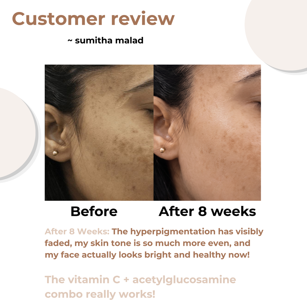 8-week before and after customer review showing faded hyperpigmentation and a brighter, more even skin tone using the Vitamin C and Acetylglucosamine serum combo